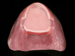 Figure 13  Maxillary and mandibular record bases with central bearing device mounted using light-activated laboratory resin.