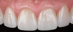 Fig 6. Anterior crowns fabricated from monolithic 4Y zirconia, which was chosen
because of its desired balance of strength and translucency.
