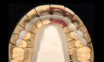 Fig 9. Zirconia coping in which all functional movements
of the opposing teeth are located on the coping (Fig 9, occlusal view)
