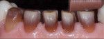 Fig 13. Tooth preparations
showing dark discoloration.
