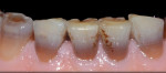 Fig 12. Discolored mandibular incisors.