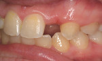 Figure 1  Preoperative photograph of a missing maxillary right lateral incisor.