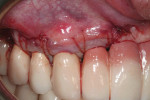 Fig 6. Mucogingival tissues secured over
ADMs to correct recession defects.