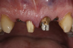 Fig 1. Initial intraoral situation after removal of the tooth-supported provisional prosthesis.