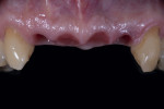 Fig 4. Frontal view after soft-tissue conditioning with the implant-supported provisional prosthesis.