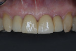 Fig 14. Frontal view of definitive monolithic zirconia prosthesis.