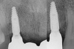 Fig 15. Post-treatment radiographs showing stable results. (Radiographs are joined together to show both implants post-treatment.)