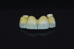 Fig 12. Zirconia prosthesis stained before sintering.