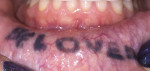 Fig 1. Ornamental ink tattoo of the lower orolabial mucosa.