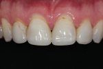 Comparison of pre- and postoperative retracted close-up maxillary views.