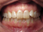 Pretreatment retracted anterior view of new patient requesting clear aligner treatment to correct tooth No. 10.