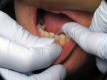 Interproximal reduction performed by hand where necessary to permit planned tooth movement.