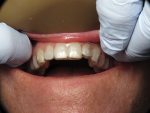 Sixth aligner in place prior to interproximal reduction.
