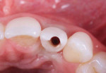 An implant-supported provisional restoration with the access hole to the implant screw on the facial aspect and incisal edge.
