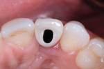 An abutment with an angled screw channel modified the position of the access hole, allowing for the design of a screw-retained porcelain-fused-to-zirconia final restoration.
