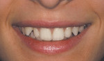 Figure 3  Before Invisalign (natural smile).