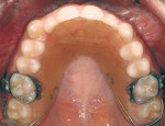 Figure 4  Before Invisalign (maxillary arch).