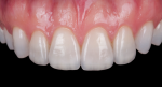 Fig 17. Six months after the restoration, intraoral and extraoral images show a much more esthetic smile.