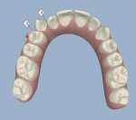 Figure 7  ClinCheck screenshot (maxillary occlusal shot).