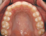 Figure 8  After Invisalign (maxillary arch).