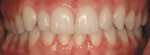 Figure 9  After Invisalign (retracted smile).