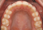 Figure 12  After veneers (maxillary arch).