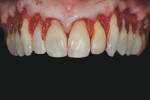 Incision design for the maxillary arch. Note how the interproximal papilla between the central incisors is left intact to improve the final esthetics.