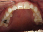 Retracted open mouth maxillary view after completion of clear aligner treatment.