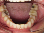 Retracted open mouth mandibular view after completion of clear aligner treatment