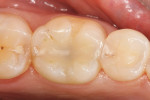 Figure 1  Preoperative views of the worn occlusal-facial composite restoration on tooth No. 19.