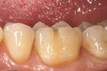 Figure 2  Preoperative views of the worn occlusal-facial composite restoration on tooth No. 19.
