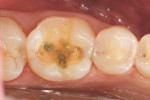 Figure 3  Occlusal view of the conservative onlay preparation with 1.5-mm occlusal clearance.