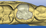 Figure 5  Proposal of the onlay restoration for tooth No. 19.