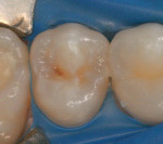 Figure 1  Preoperative view of tooth No. 4 showing occlusal and distal caries that was noted radiographically.