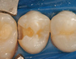 Figure 2  A conservative slot preparation was completed and caries removed.