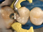 Figure 8  The uncured composite was condensed with a P-1 Plugger lubricated with an unfilled resin (Heliobond) to create occlusal anatomy prior to curing.