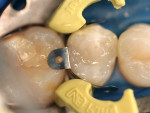 Figure 9  Occlusal view of the contoured restoration prior to curing.