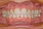 Preoperative retracted view with teeth closed.