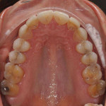 Preoperative occlusal view of the maxillary arch.
