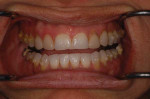 Retracted view with teeth slightly open following orthodontic treatment but prior to restoration. Note how the occlusal plane of the intruded maxillary posterior teeth is no
longer inferior to that of the anterior teeth.