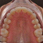 Final occlusal view of the maxillary arch.