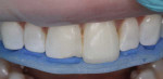 A verification jig was used to ensure the accuracy of each incisal edge position.
