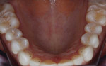 Posttreatment mirror view of the mandibular contacts.