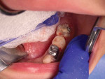 Dentin substitute material placed into the SDF treated cavity.