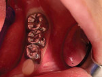 Interim “final” stainless steel crown restorations placed over tooth K and tooth No. 19.