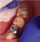 Occlusal caries noted on tooth K during placement of dentin substitute.