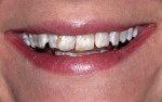 Figure 2  While the crowding and uneven coloration led the patient to seek cosmetic treatment, the cant and midline position needed correction. The first treatment consideration was to do orthodontics to alleviate crowding but decay necessitated rest