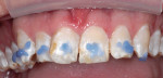 Figure 4  A direct composite mock-up before anesthesia is key for cosmetic acceptance. Etching was done to keep composite on the teeth during shaping and impressions.