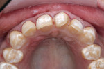 Figure 7  After decay removal, small composite build-up and final shaping were done. Reduction was done only to meet the esthetic and functional goals of the case.