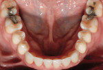 Figure 20  Mandibular occlusal view with restorations Nos. 22 to 27 and equilibration complete.